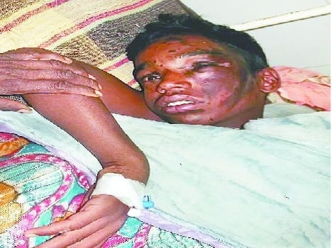 The procession came to acid attack on four teenagers